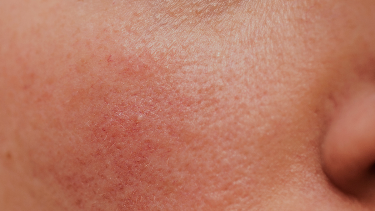Rosacea & Sensitive Skin