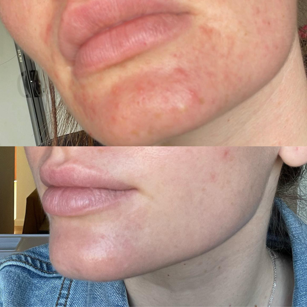 Redness Repair Set