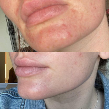 Redness Repair Set