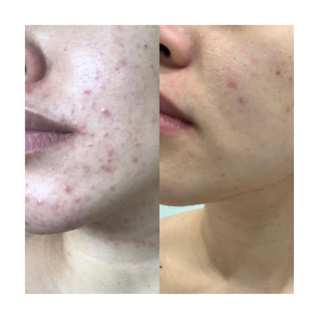 Adult Acne Relief Set
