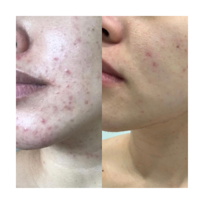Adult Acne Relief Set