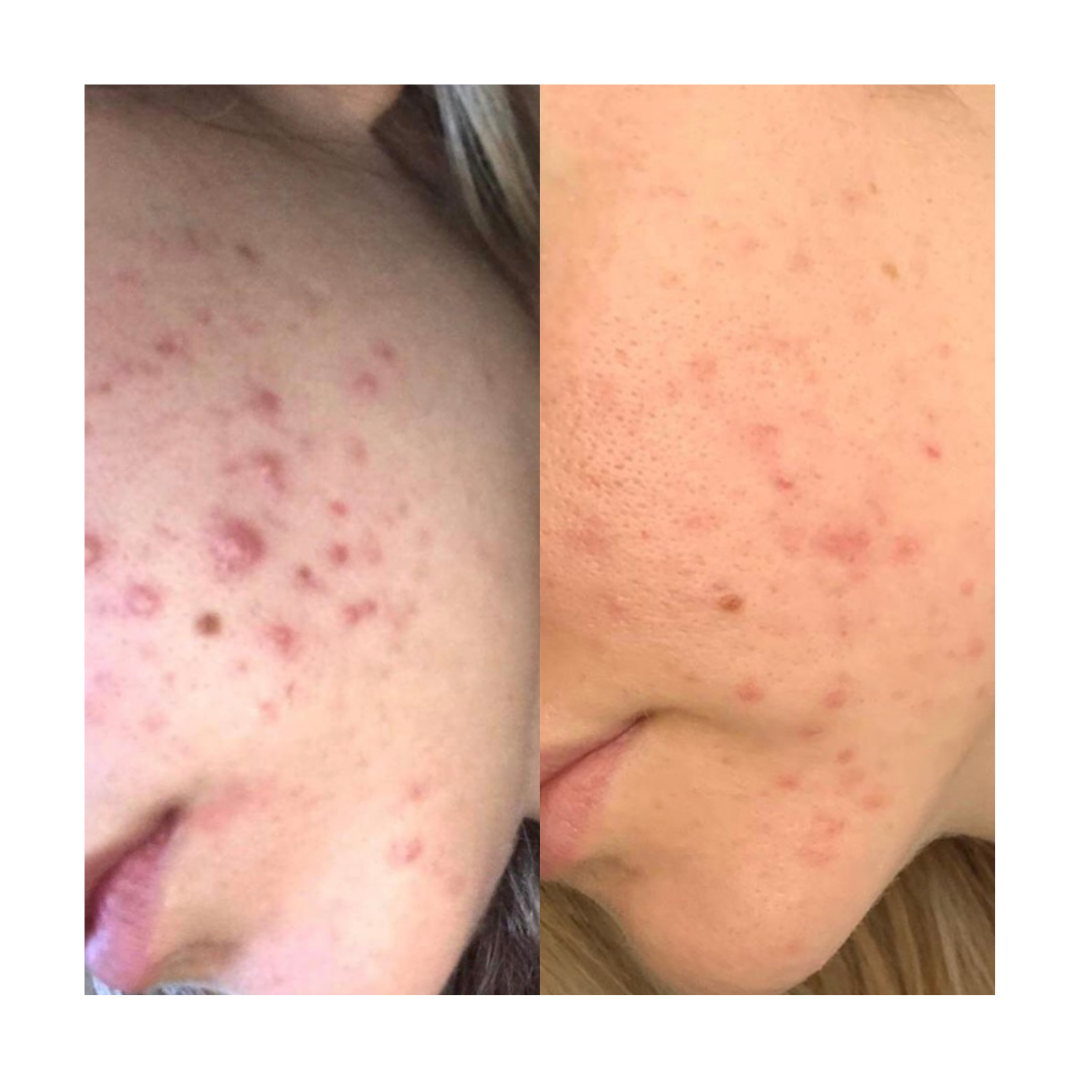 Adult Acne Relief Set