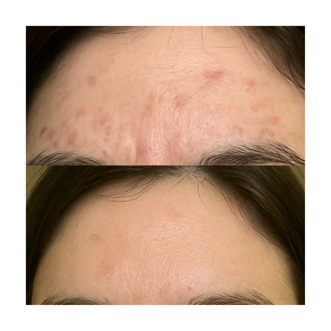 Adult Acne Relief Set