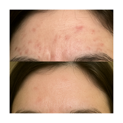 Adult Acne Relief Set