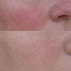 Redness Repair Set