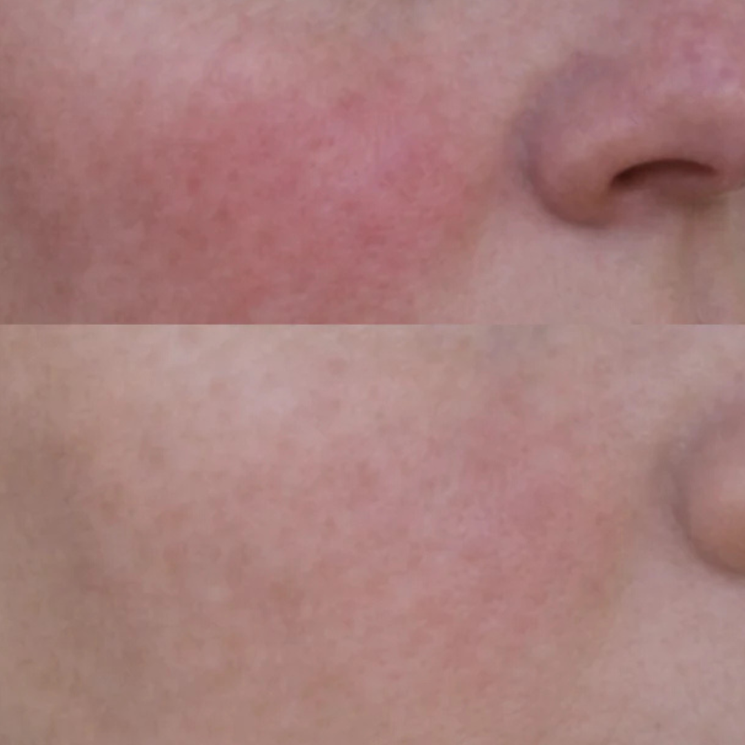 Redness Repair Set