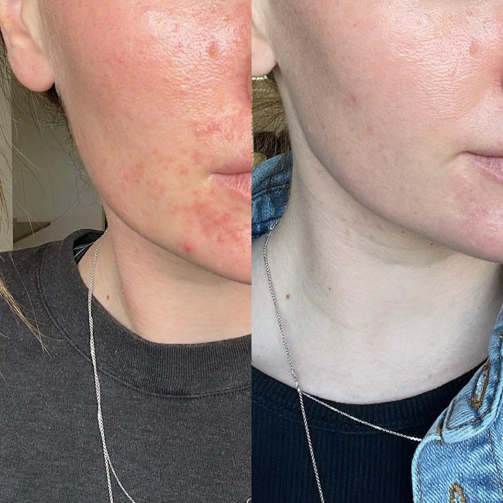 Redness Repair Set
