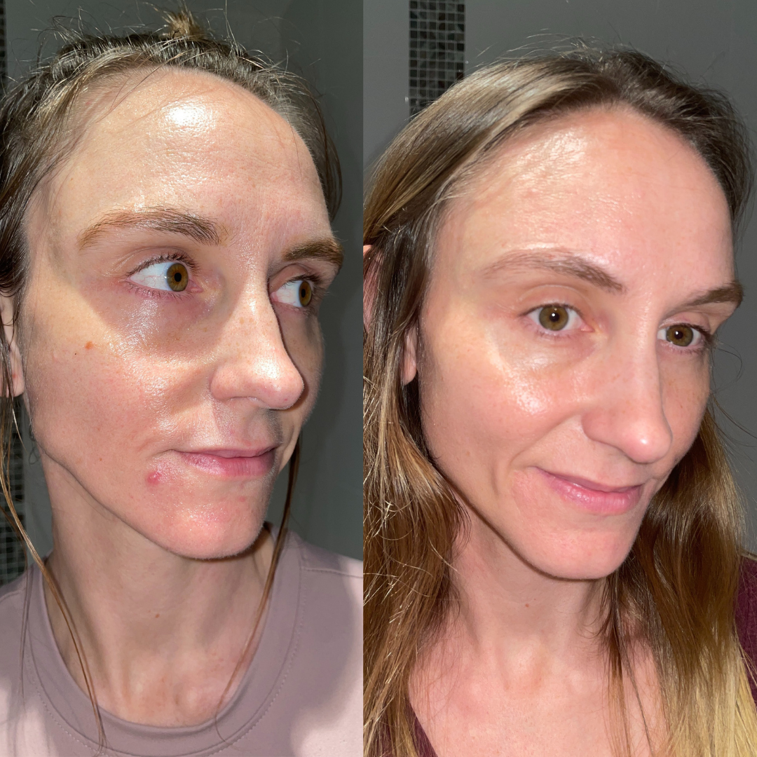 Adult Acne Relief Set