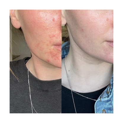 Adult Acne Relief Set